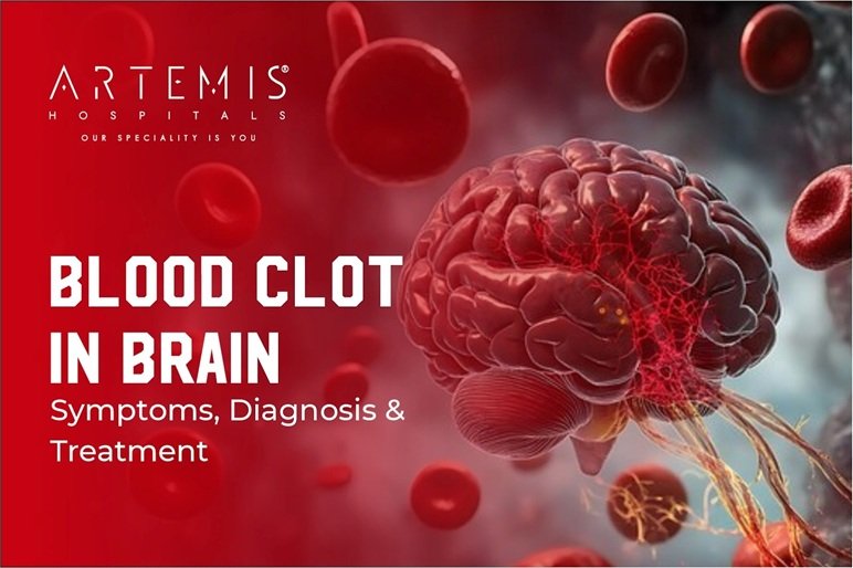 Signs and symptoms of a brain blood clot